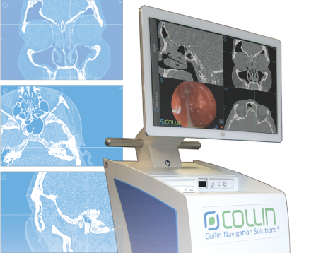 System elektromagnetycznej Neuronawigacjii  Laryngologicznej